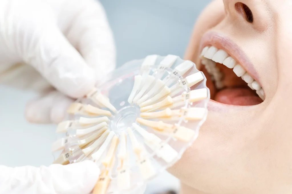 Blanqueamiento dental: Dentista comparando los dientes blancos de la mujer con las muestras